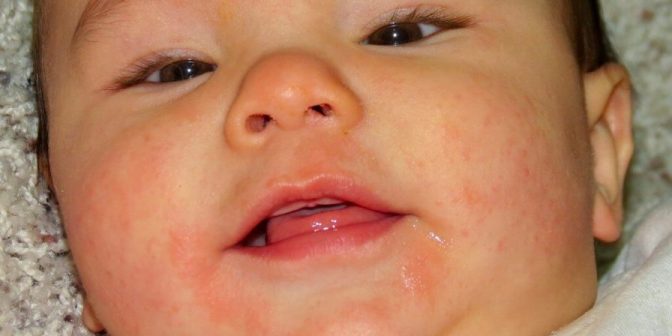 Jenis alergi dan cara mencegah alergi pada anak