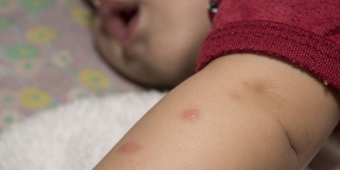 Gigitan nyamuk pada bayi