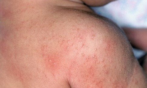alergi kulit pada bayi
