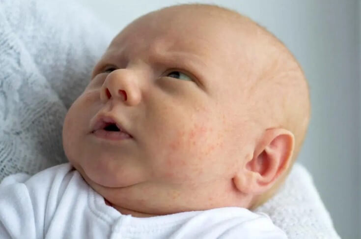 penyakit kulit pada bayi.jpg3.jpg