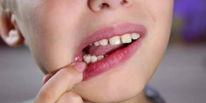 Gigi Susu Anak: 6 Fakta, Masalah Umum, Cara Merawat 2