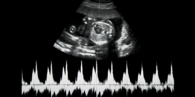 Perkiraan Dengan Mendeteksi Detak Jantung Bayi