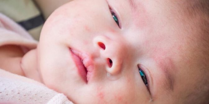 bintik merah pada bayi Sumber Medicalnewstoday.com