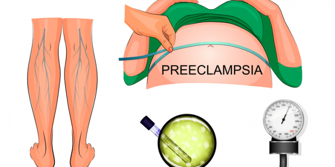 eklampsia pada kehamilan 