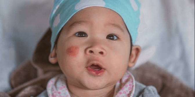 Eczema pada Bayi