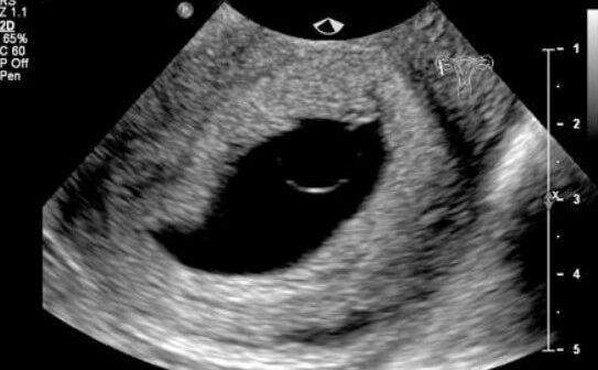 kehamilan kosong via radiopaedia.org