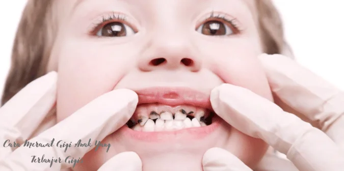 Cara Merawat Gigi Anak Yang Terlanjur Gigis