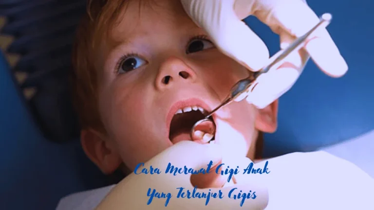 Cara Merawat Gigi Anak Yang Terlanjur Gigis