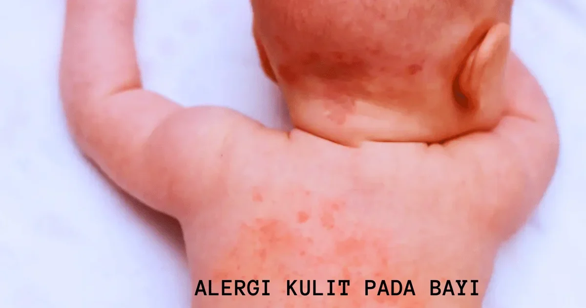 Alergi Kulit pada Bayi