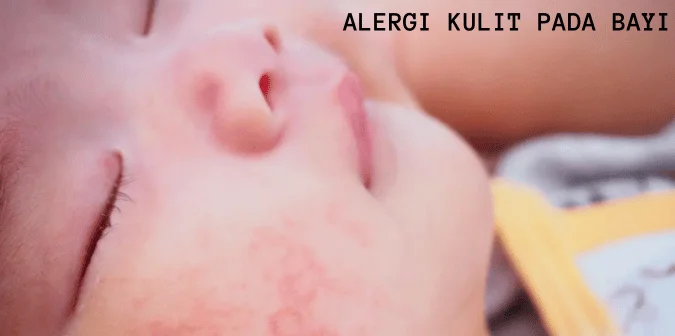 Jangan Panik! 4 Cara Menangani Alergi Kulit pada Bayi dengan Tepat 1